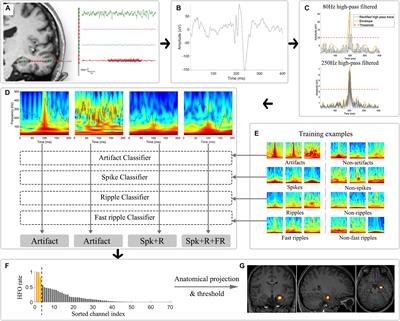 Integrated Automatic Detection, Classification and Imaging of High Frequency Oscillations With <mark class="highlighted">Stereoelectroencephalography</mark>